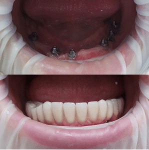 Імплантація зубів, Київ: фото після установки