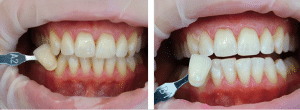Лазерне відбілювання зубів: до після
